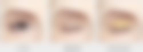 做双眼皮需要恢复多少时间？揭秘术后护理与恢复小贴士！一般1 - 6个月，这些护理助快速恢复！ 