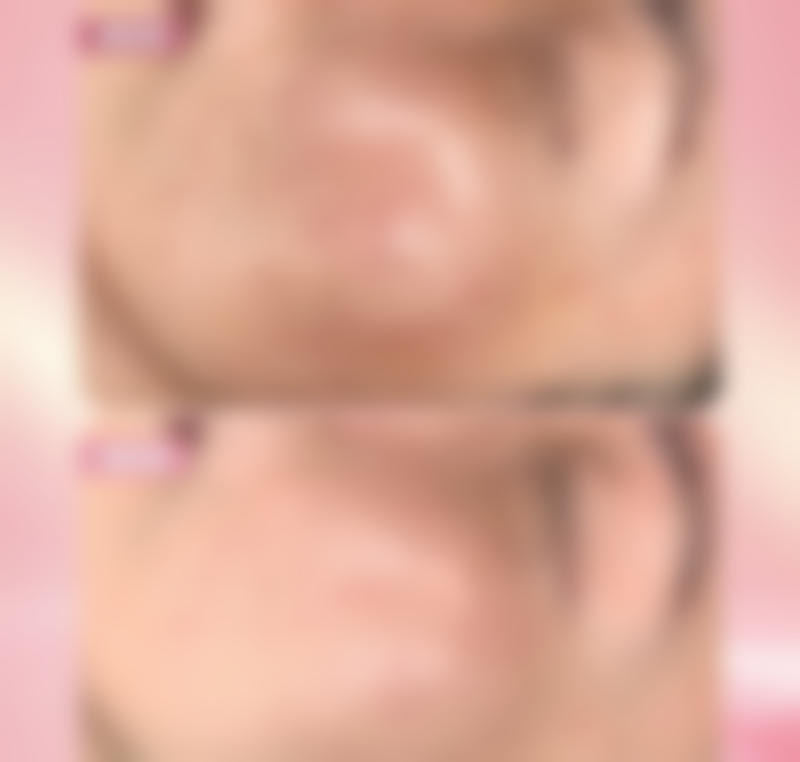 疤痕增生治疗后有哪些日常护理建议？