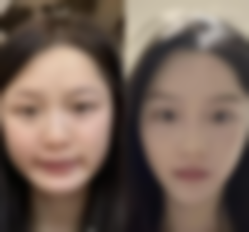 什么是增生疤痕？