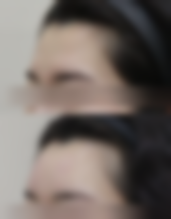 怎么样能去痘痘的疤痕？之护理手段解决痘疤问题