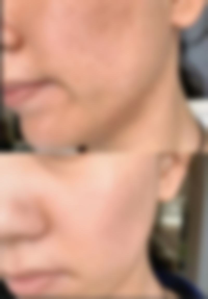 八、颧骨宽伴随特殊情况该怎么处理？