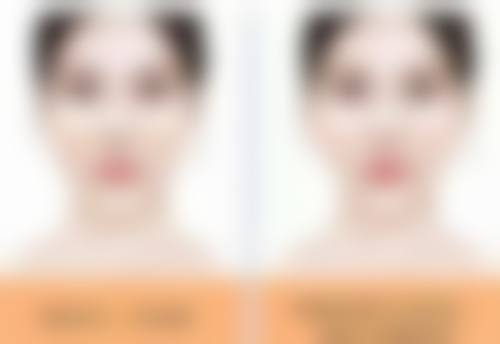 治疗扁平性疤痕后要注意什么？