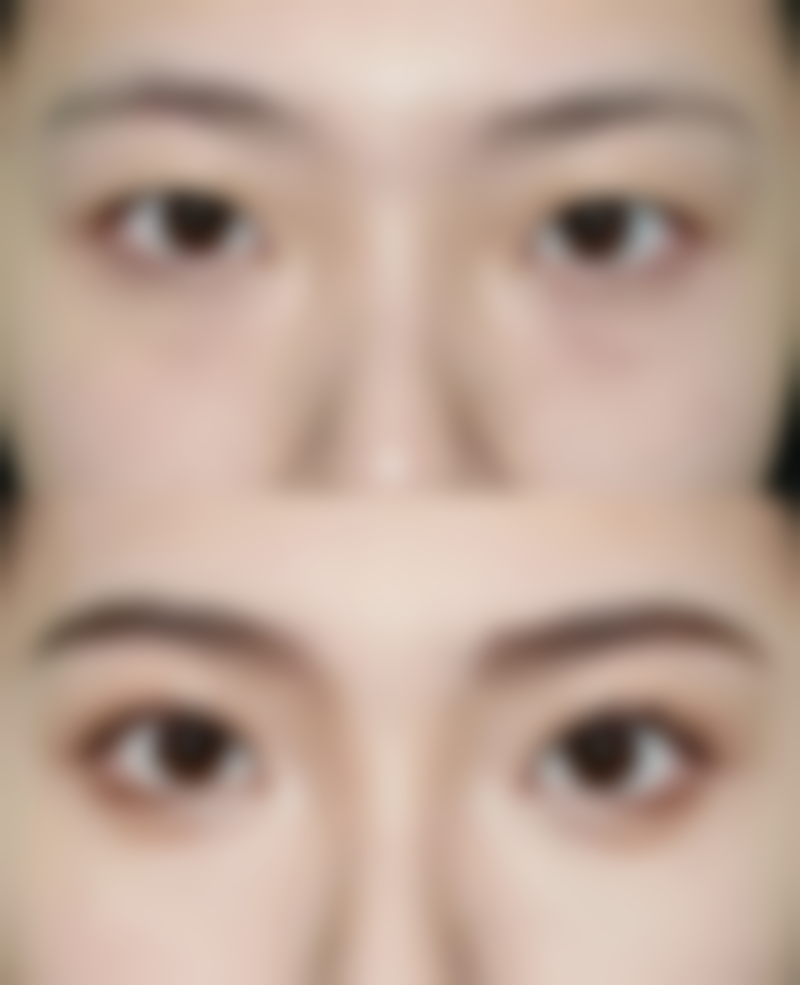 可以抽脂减肚子吗？揭秘抽脂手术的真实效果与风险分析！术后反弹几率大吗？ 