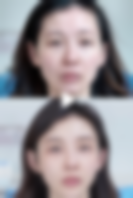 祛眼袋激光和传统手术祛眼袋有什么区别？