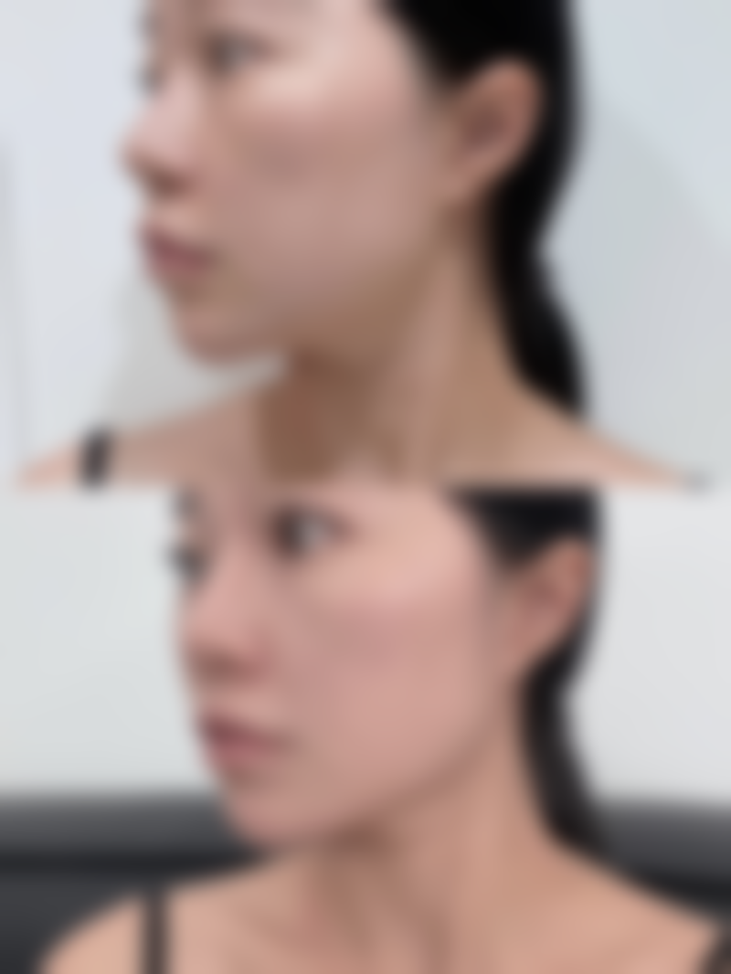 开塞露可去眼袋吗？揭秘这一医美新趋势的真实效果与安全性！它真能替代昂贵的医美手术吗？ 