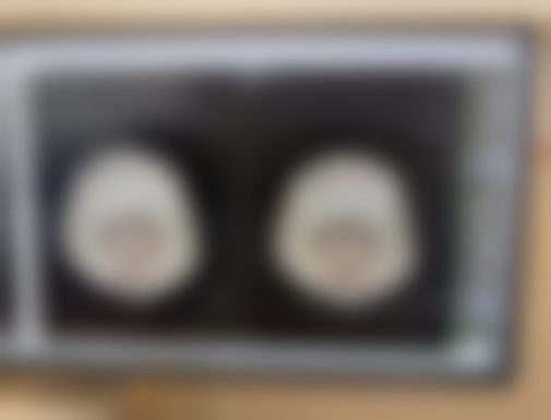 科学去眼袋有哪些方式呢?