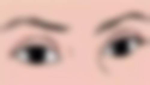 其他因素会让双眼皮变成单眼皮吗？