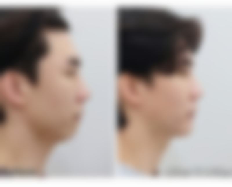 广州新发现植发医院黄香枚医生眉毛种植技术怎么样？