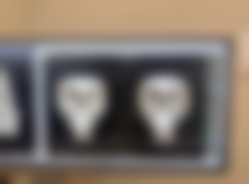 问题四：眼袋治疗方案有哪些，各有什么特点？