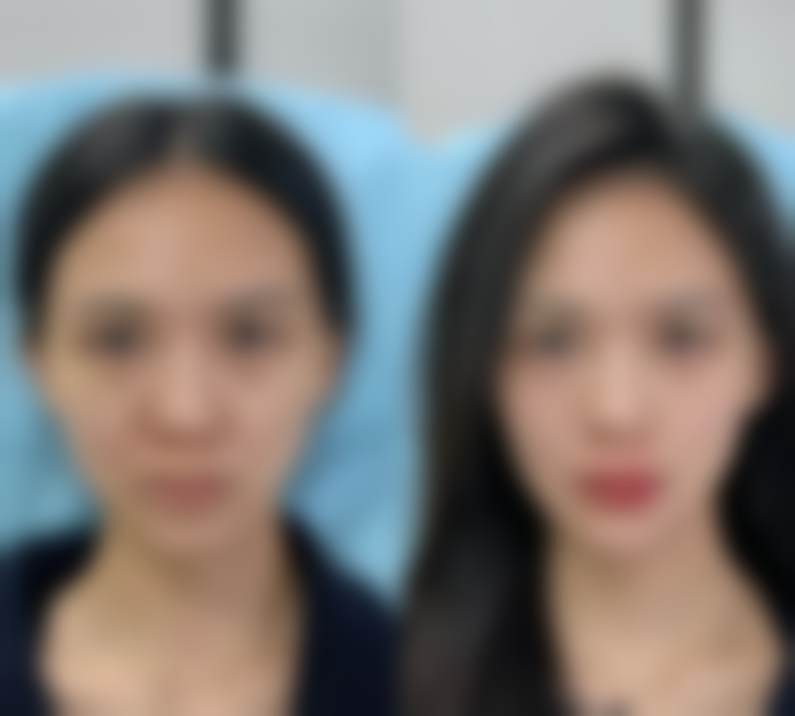 有效的去疤方法有哪些呢？