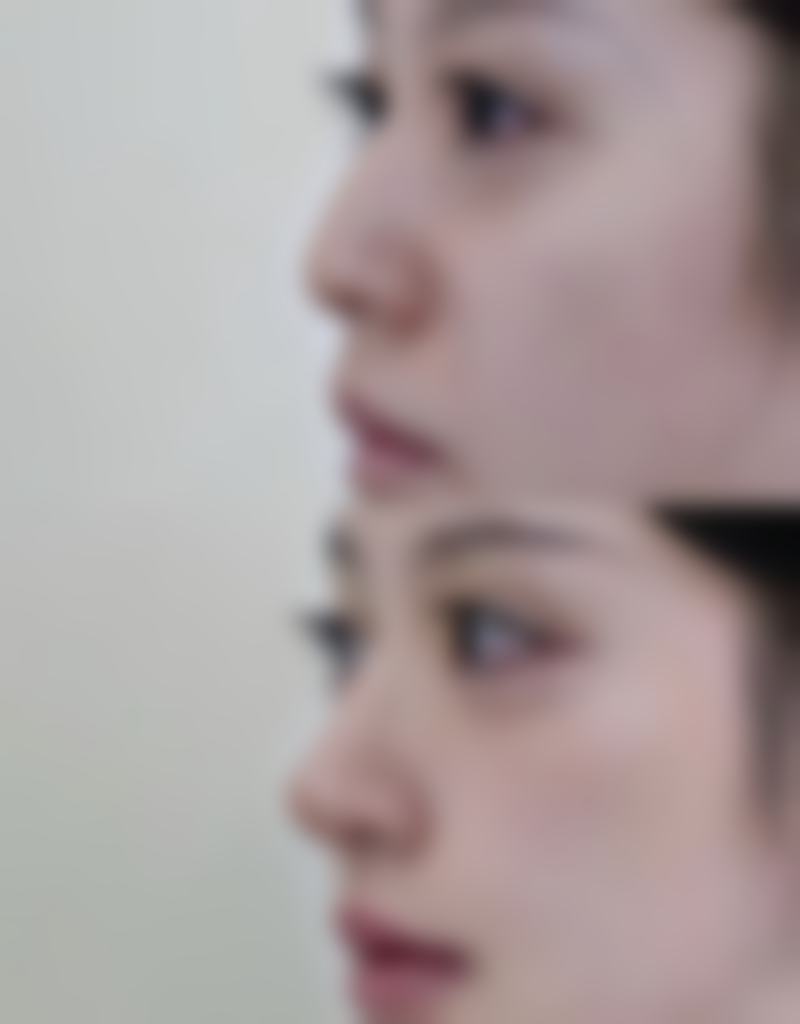 南充市中 心医院田超医生双眼皮修复技术怎么样？