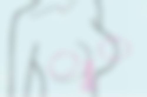 术后修复期该如何护理?