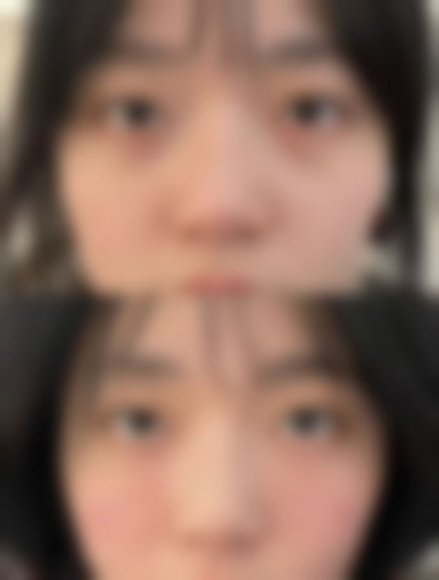 双眼皮能维持一辈子吗？揭秘持久效果与护理秘诀！哪种术式维持久且恢复快？ 