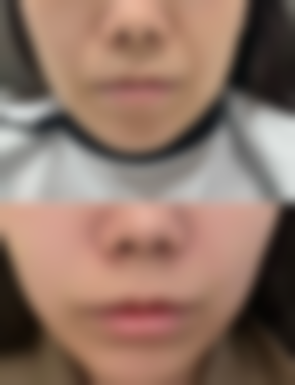 问题3:瘢痕红印的医美治疗细分方案都有什么特点?