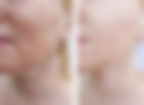 华美双眼皮修复的价格是怎样的呢？