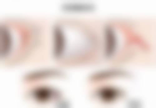 面部吸脂手术的麻醉方式有哪些？