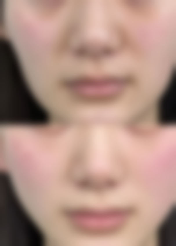 常见的双眼皮失败问题有哪些，华美是如何解决的呢？