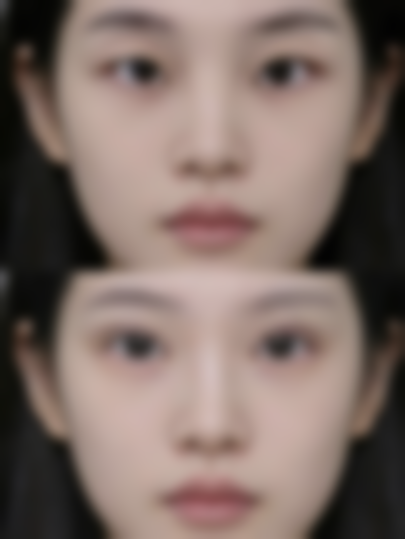 韩国815抗衰老中 心朴性垠医生埋线提升技术怎么样？