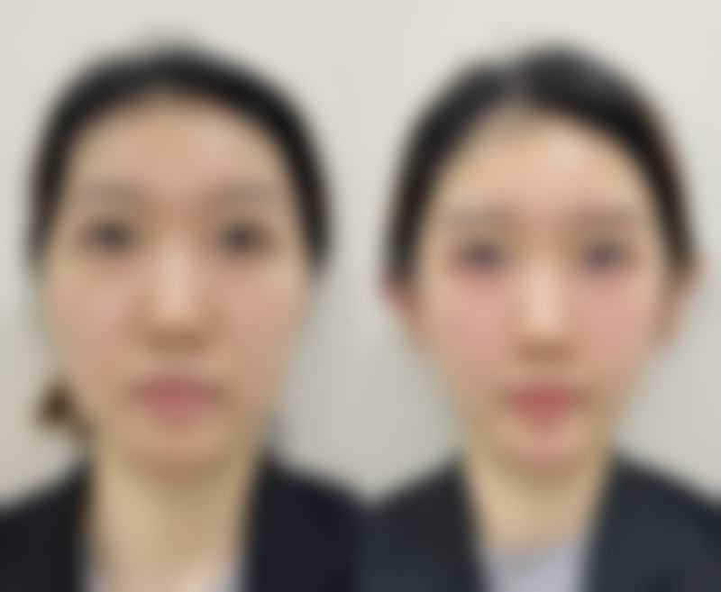 术后如何维持塑形成效？