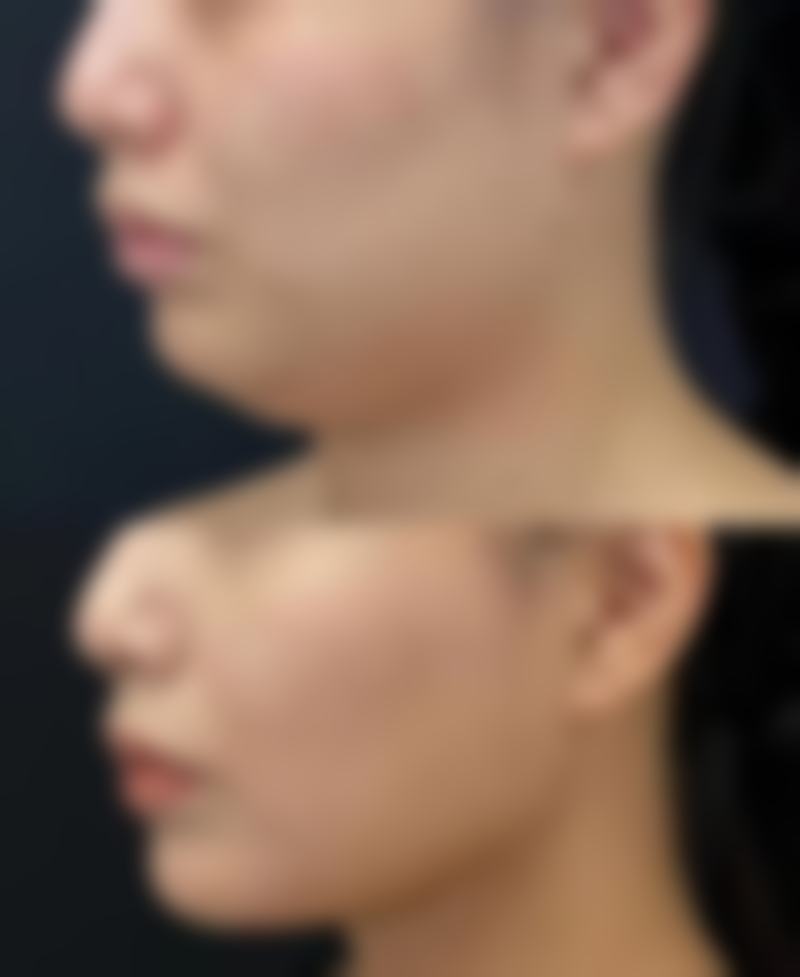 激光溶脂和吸脂手术分别适用于哪些场景？