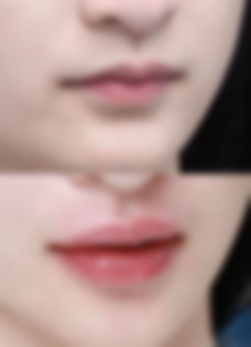 植发总费用受哪些因素影响？