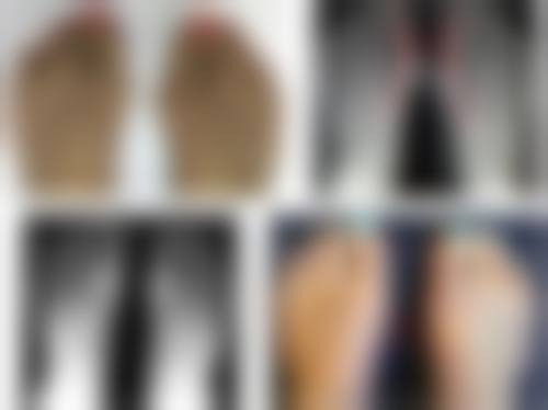 埋线双眼皮术后有哪些护理建议？