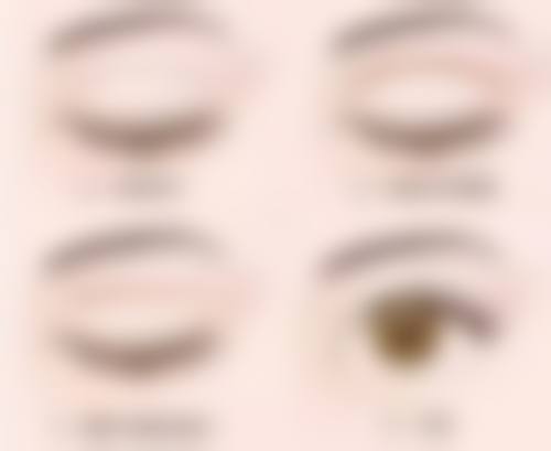 不同医生对于埋线双眼皮维持时间有哪些观点？