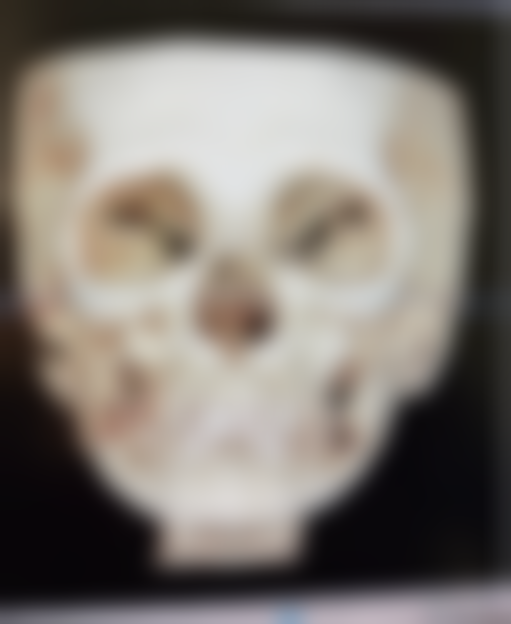 如果眼袋伴有重度皮肤松弛该怎么办?