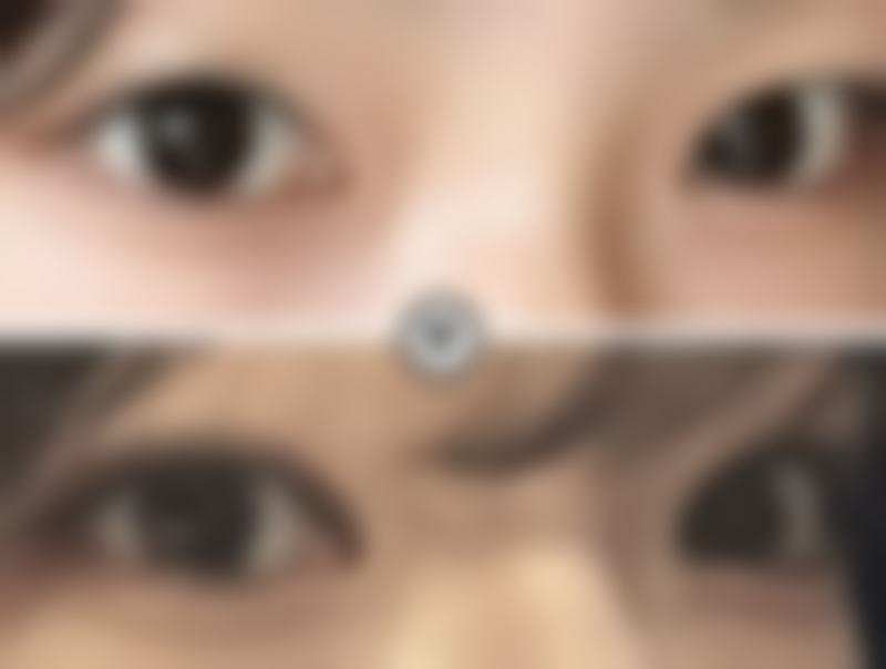 双眼皮埋线是永久性的吗？揭开医美行业的真实秘密！答案：非永久，效果通常维持3 - 5年！ 