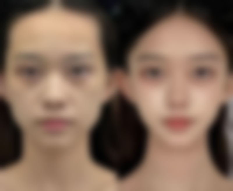 常规无并发症情况下,不同假体隆鼻后至佳取出时间是怎样的?