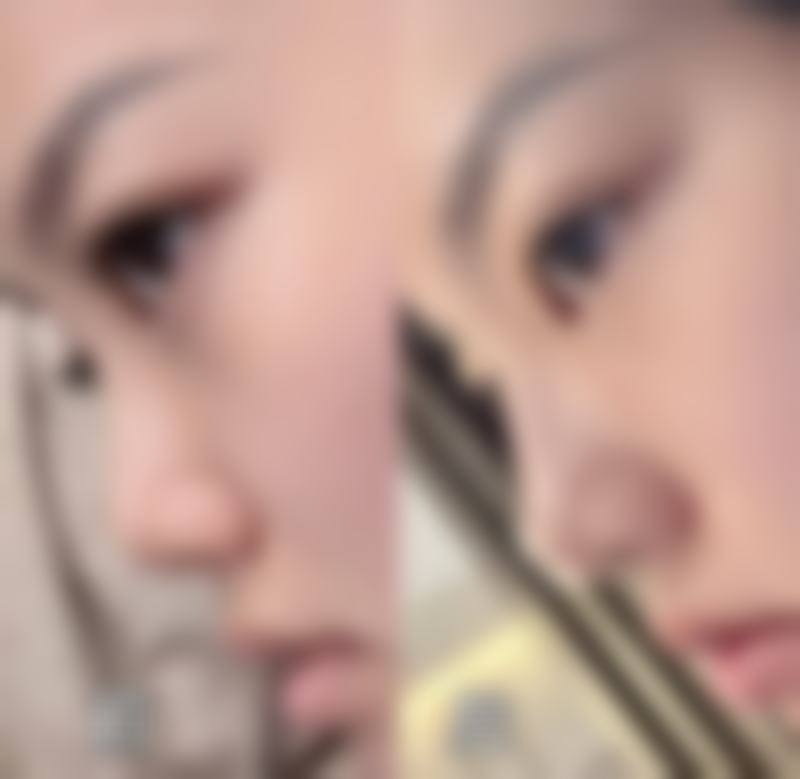 隆鼻后多久可以取假体？专家解答你不能错过的恢复时间！恢复时间和哪些因素有关？ 