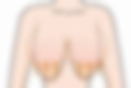 眼膜能去除眼袋吗？