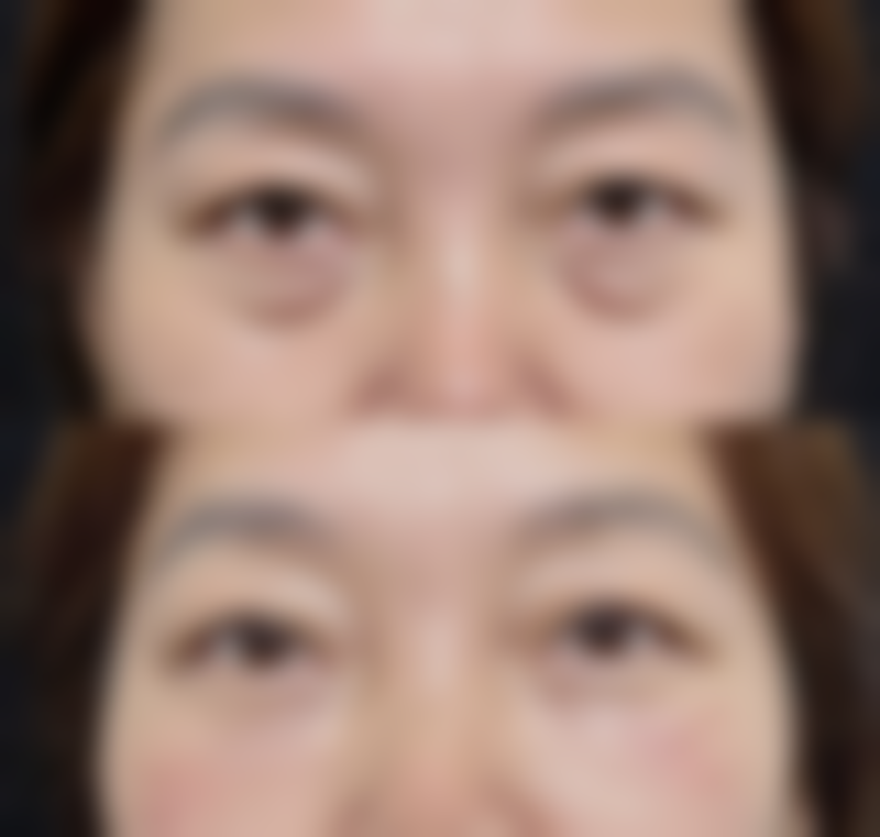 真的有产品能完全去除眼袋吗？