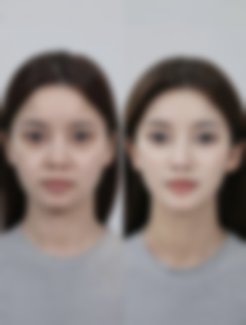 韩式三点双眼皮修复术后护理有哪些要求呢？