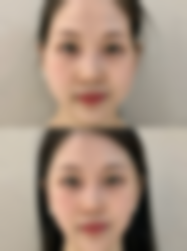 手术后要怎么护理呢？