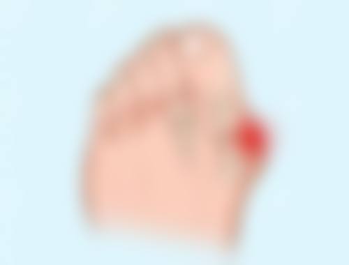 有哪些促进肉条消退的护理方法呢？