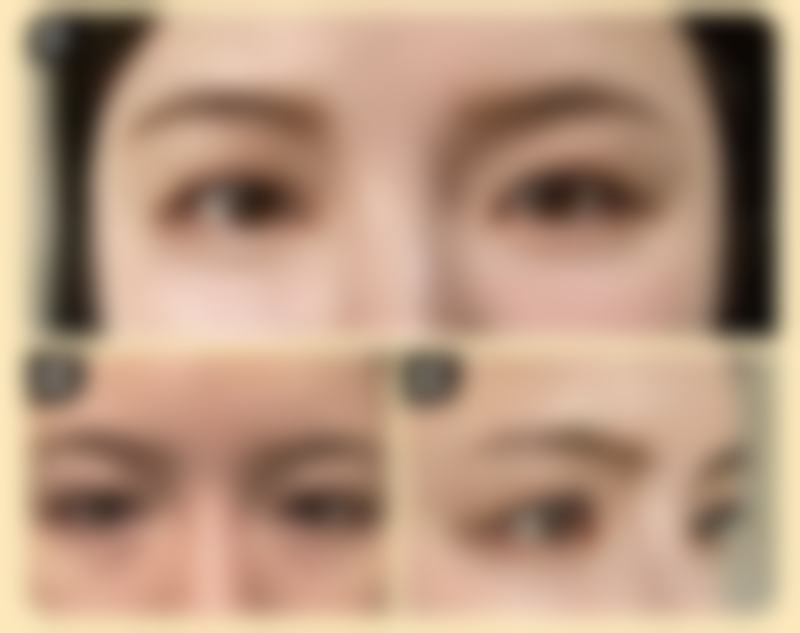 选择手术方式有什么原则吗？