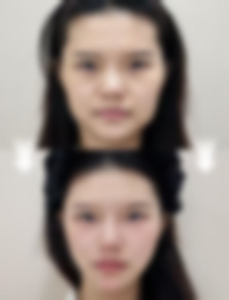 这些去除脂肪型眼袋的方法成效能维持多久呢？