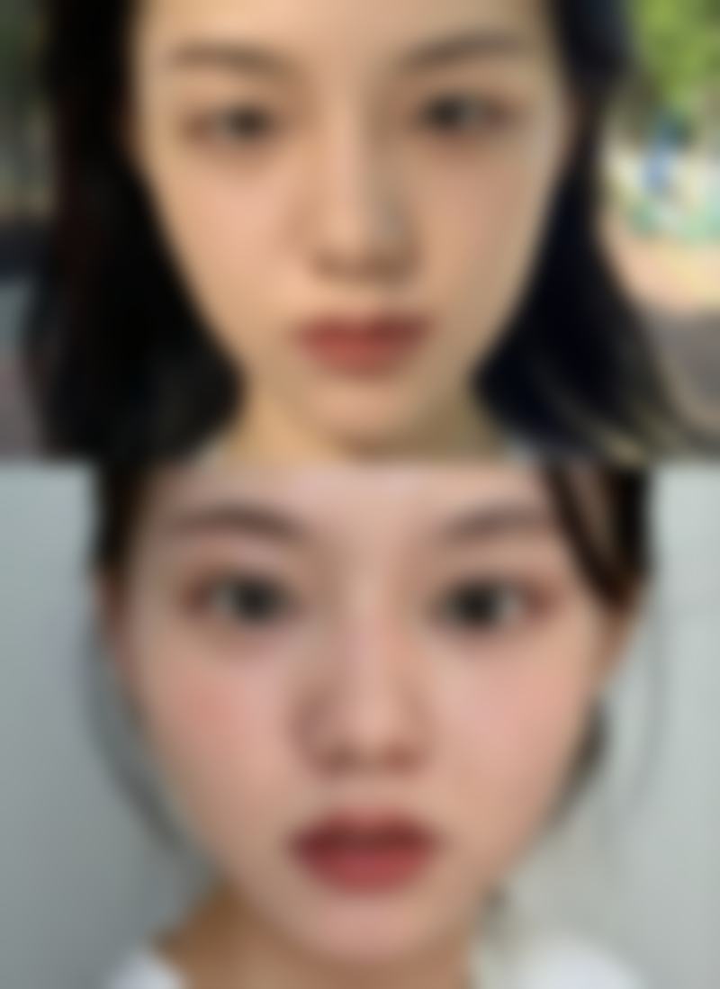 北京金炫澈整形美容医院金炫澈医生双眼皮技术怎么样？