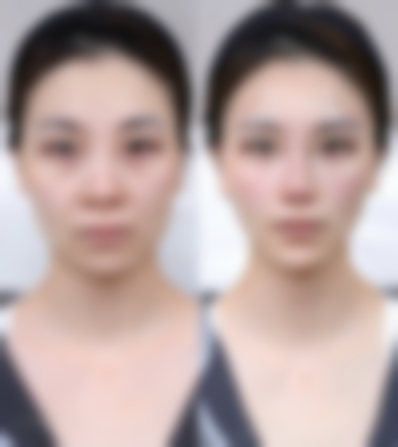 眶隔脂肪释放移位术是怎么回事，适合什么样的眼袋呢？