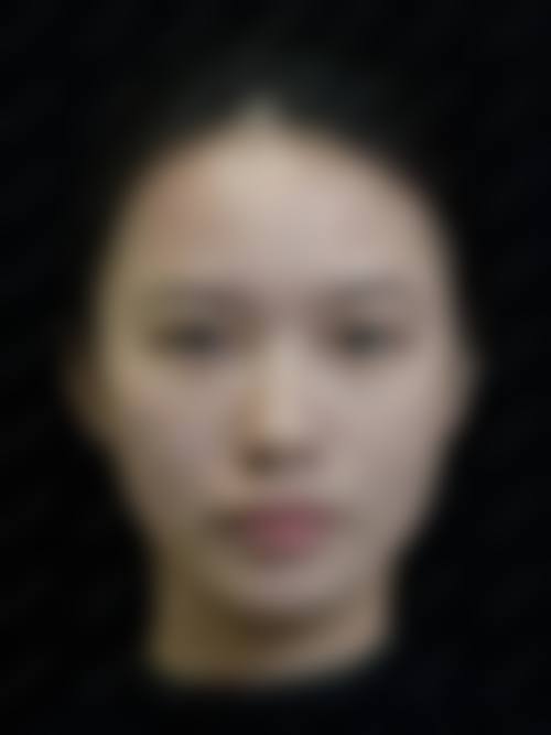 深圳阳光医疗美容医院汤莉莉医生韩式微创双眼皮技术怎么样？