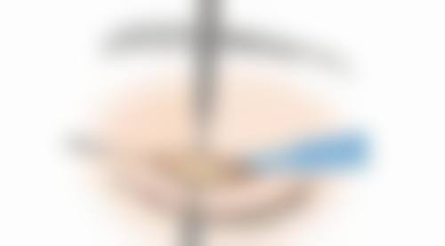 如果在哺乳期割双眼皮,对宝宝健康有何影响?