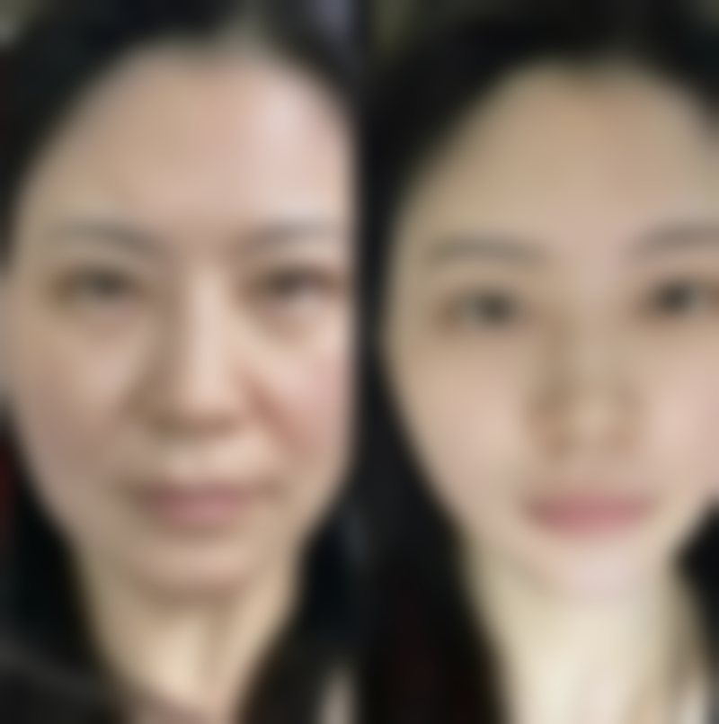 重度的双眼皮增生该如何处理？