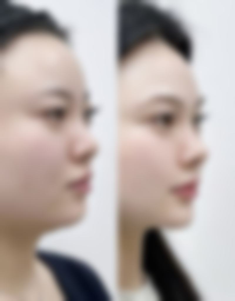 线提升隆鼻取线后可能出现哪些情况？