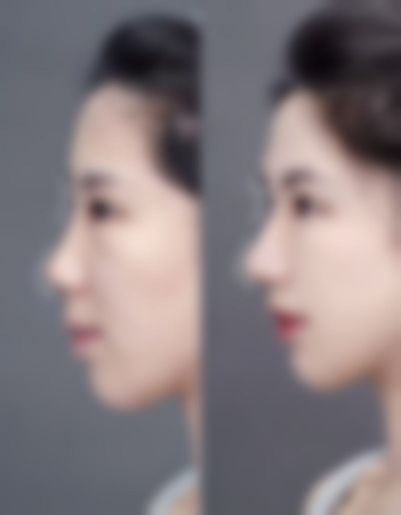 如何规避割眼袋手术的风险呢？