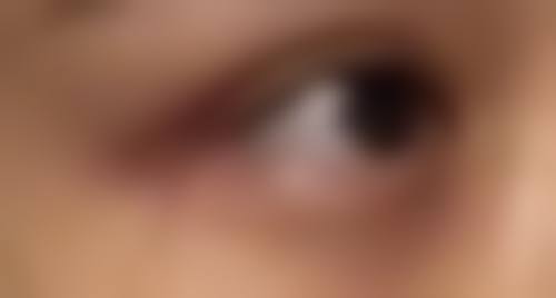 割完双眼皮可以吃杨梅吗？揭秘术后饮食禁忌与护理要点！能吃，还有这些饮食与护理秘诀！ 