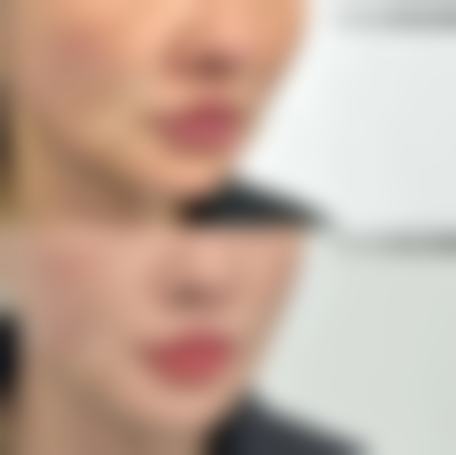 哈尔滨禾力康医疗美容医院所健鹏医生隆鼻技术怎么样？