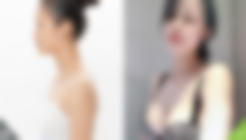 成都天使之翼医学美容医院徐爽医生热玛吉技术怎么样？