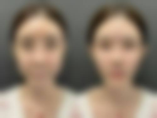 方法四：手术治疗适合哪些痘痘疤痕？