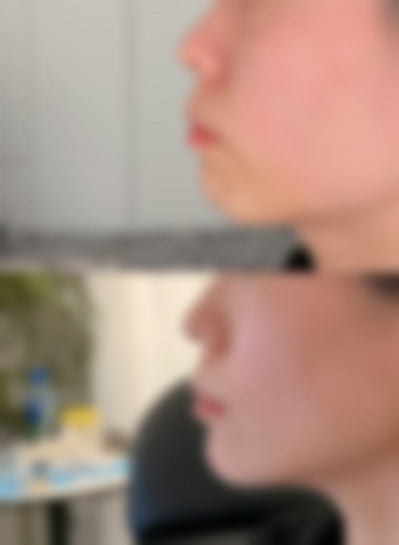 痘痘疤痕怎么去掉？揭秘5种有效方法，让你的肌肤重焕光彩！这5种方法是激光、微晶磨皮、果酸换肤吗？ 